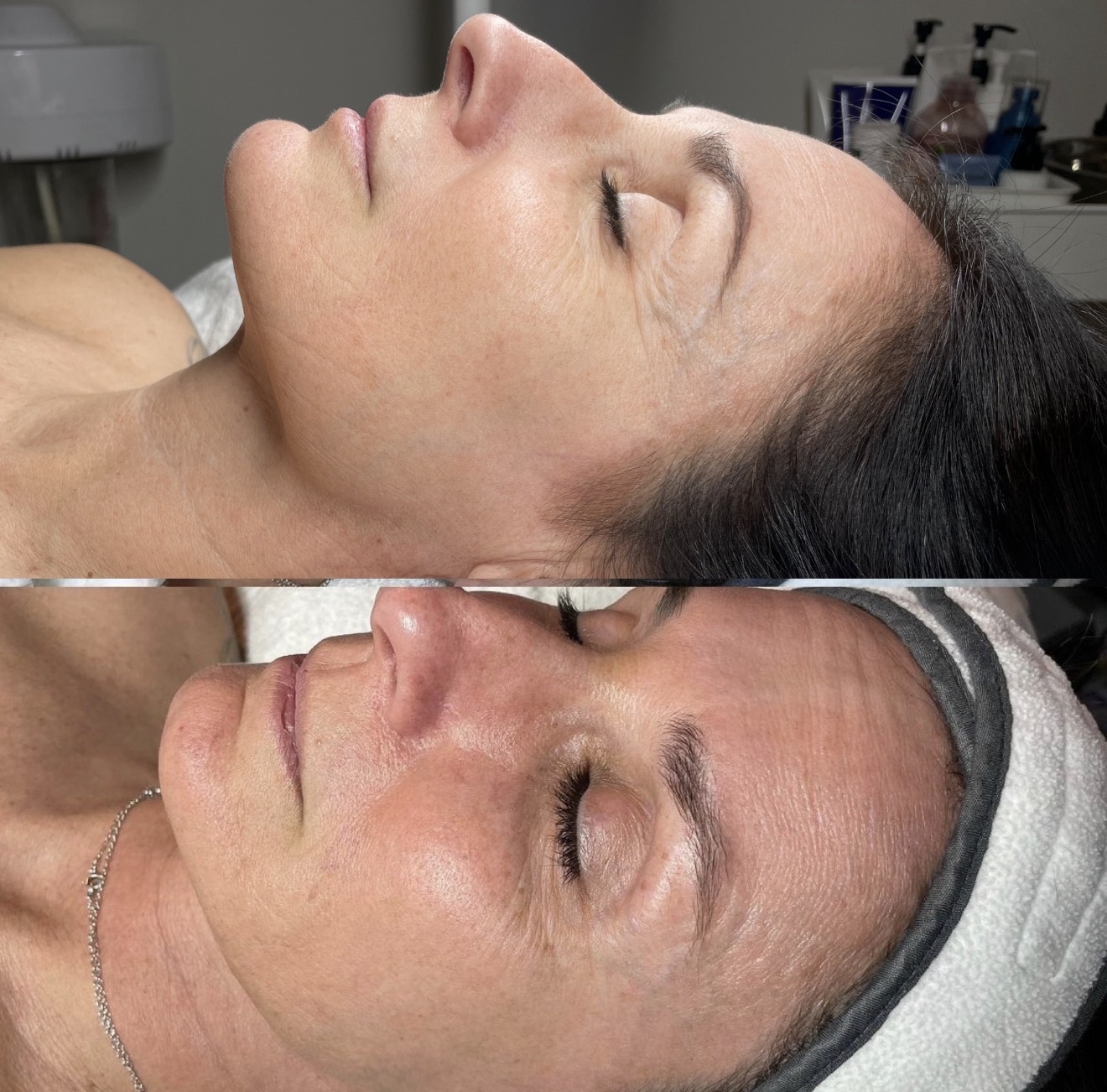 Real client before and after results at K&K Facial Spa