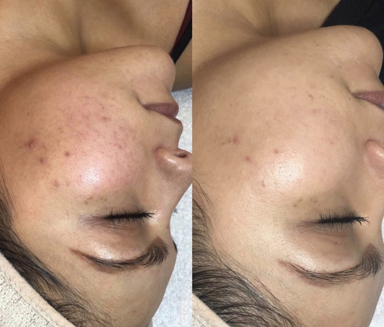 Real client before and after results at K&K Facial Spa