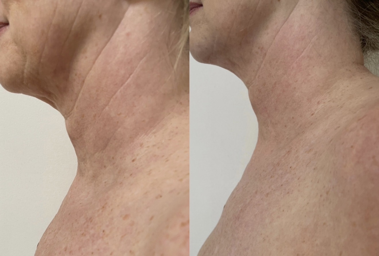 Real client before and after results at K&K Facial Spa