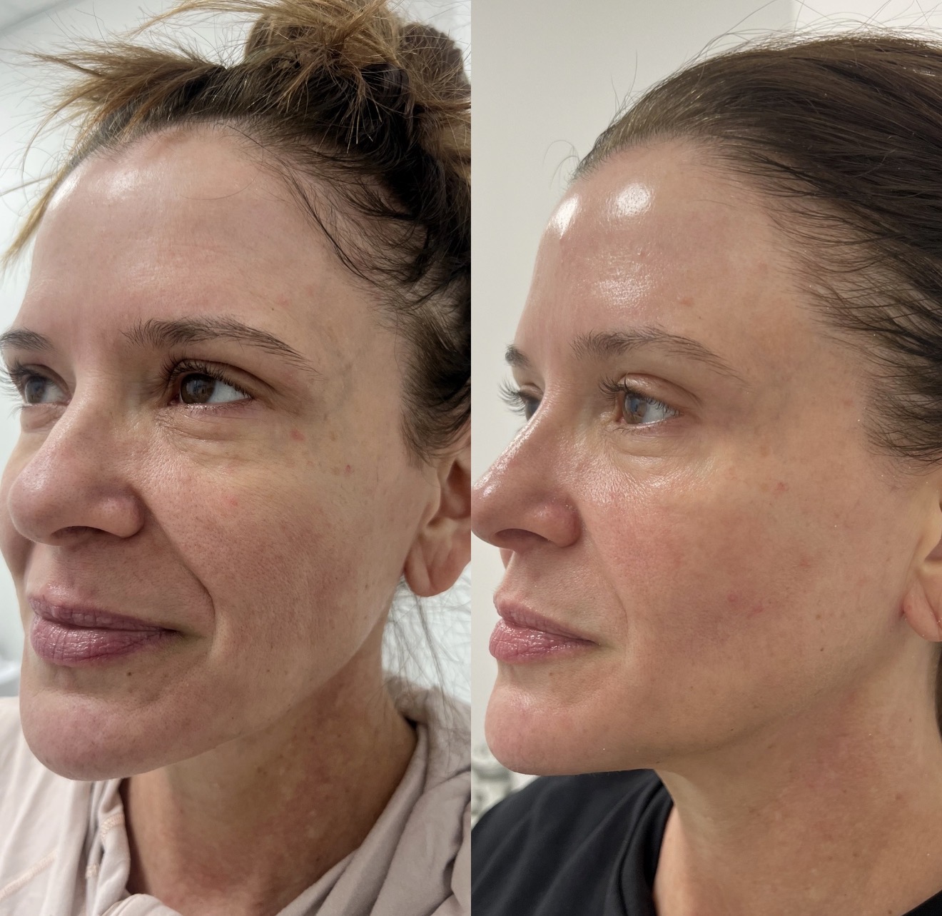 Real client before and after results at K&K Facial Spa