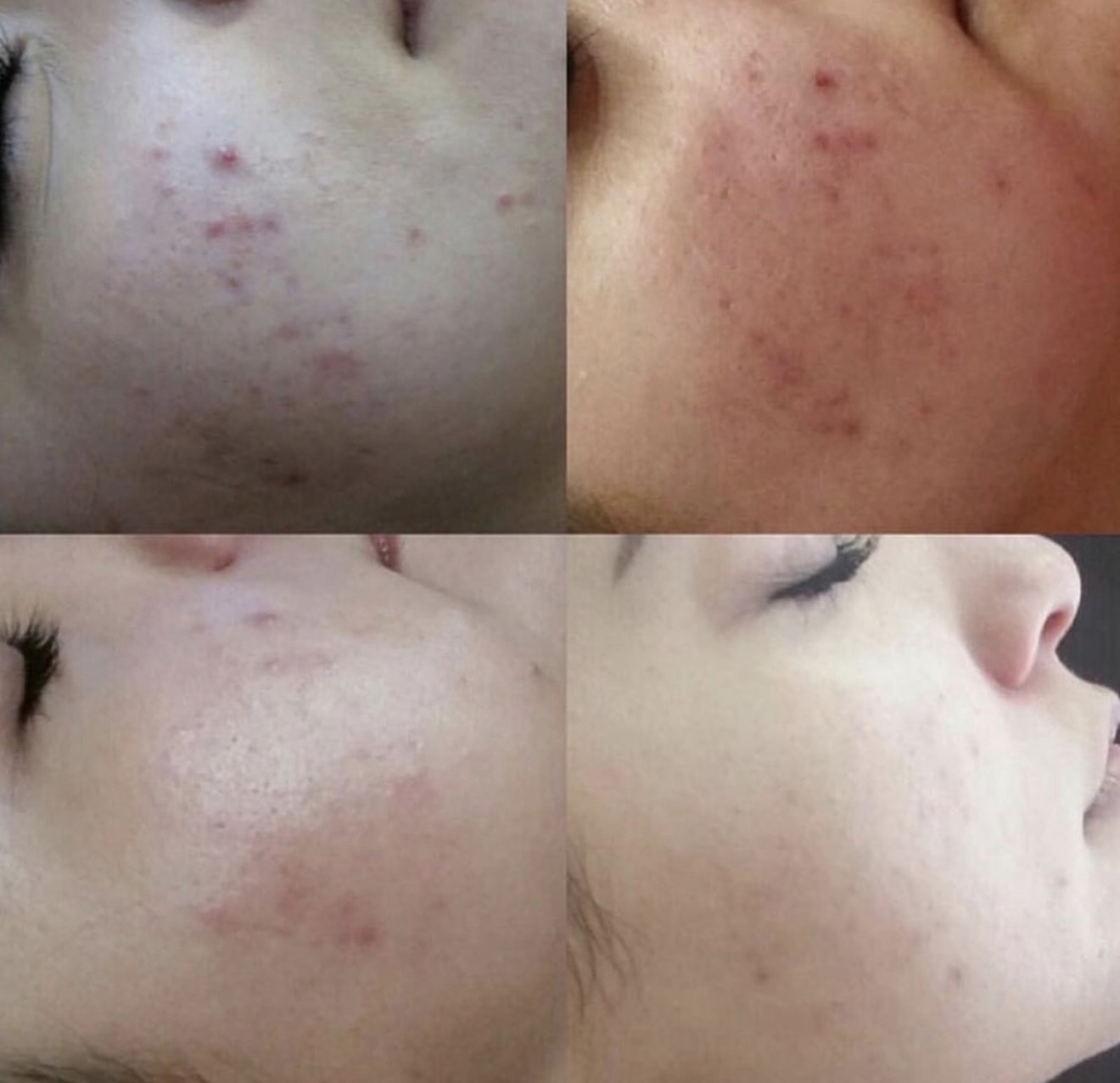Real client before and after results at K&K Facial Spa